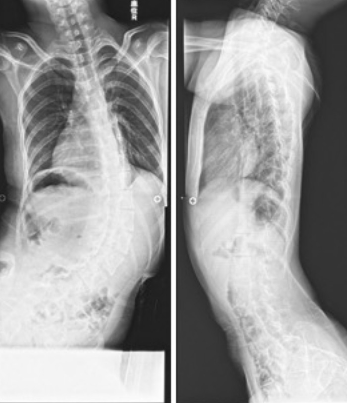 手術前のレントゲン写真(左:正面、右:側面